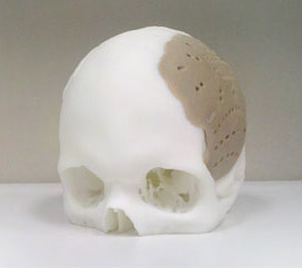Cranial Implant
